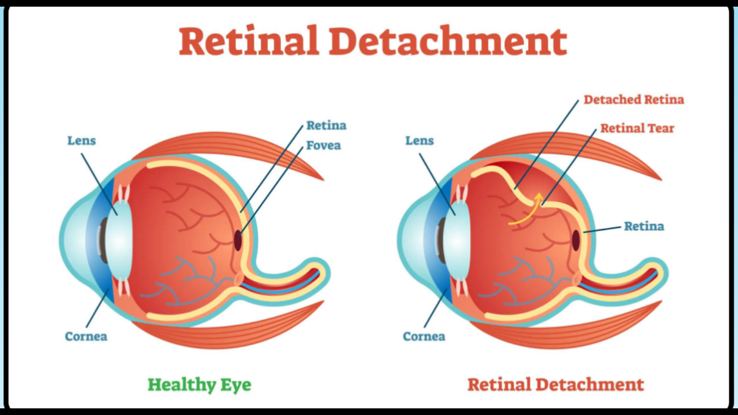 Retinal Detachment Treatment at Eye clinic in Salt Lake Kolkata